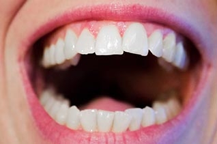 Ölziehen: Weiße Zähne?